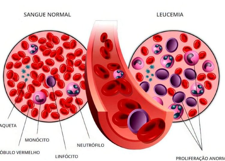 leucemia linfoide aguda B. Arte: Pfizer