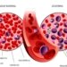 leucemia linfoide aguda B. Arte: Pfizer
