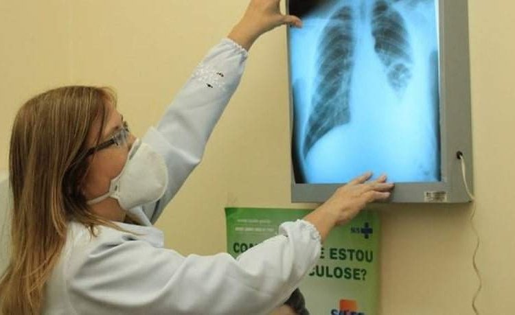 Novo medicamento do SUS reduz em 70% tempo de tratamento de casos resistentes