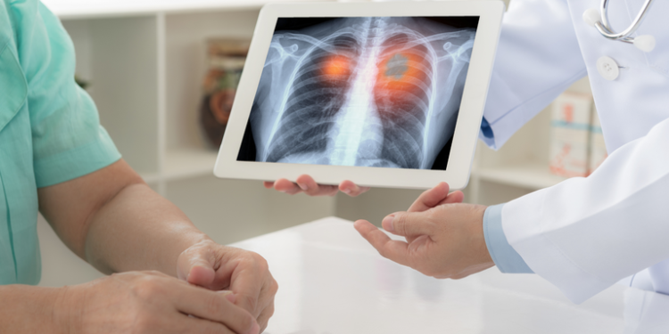 diagnósticos em estágios iniciais têm taxa de sobrevida de 80% a 90% em cinco anos, contra menos de 10% no estágio iv imagem ilustrativa freepik.