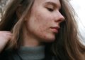 acne em uma mulher © barbara krysztofiak i via unsplash
