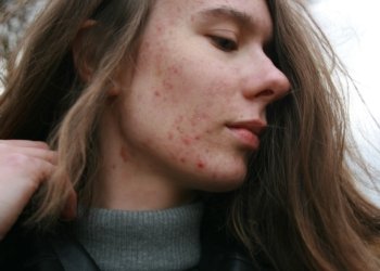 acne em uma mulher © barbara krysztofiak i via unsplash