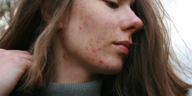 acne em uma mulher © barbara krysztofiak i via unsplash