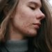 acne em uma mulher © barbara krysztofiak i via unsplash