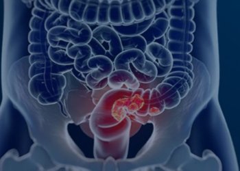SUS adota teste de sangue oculto para rastrear câncer colorretal