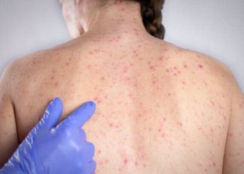 São Paulo registra 16 casos de sarampo e acende alerta para baixa cobertura vacinal