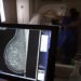 Planos de saúde passam a cobrir mamografia digital para todas as idades a partir de outubro