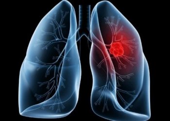 Adenocarcinoma pulmonar que acometeu o Papa Leão exige atenção a sintomas silenciosos