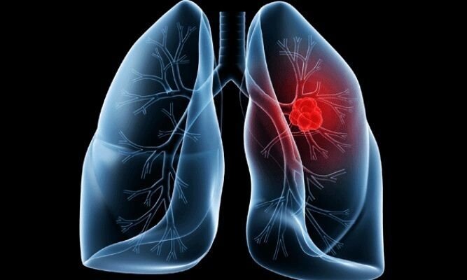 Adenocarcinoma pulmonar que acometeu o Papa Leão exige atenção a sintomas silenciosos